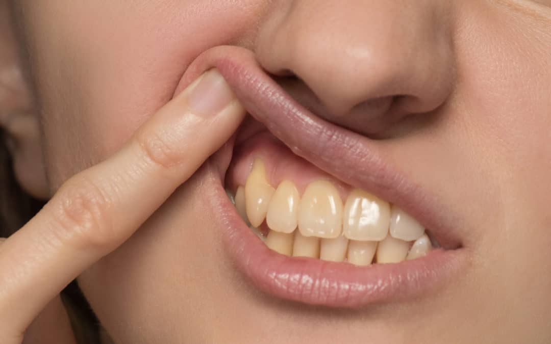 Reversing Periodontal Disease With Your Highlands Ranch Dentist
